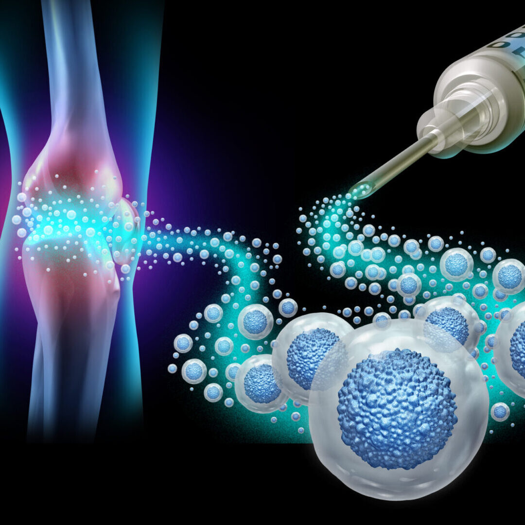 Regenerative Medicine and Mesenchymal Stem Cells injected for Knee joint pain to regenerate tissue repair as a cell therapy medical close up macro view showing a sports injury or a physical work accident.